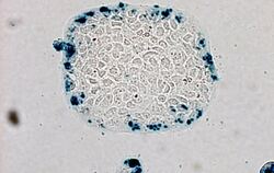 Eine mikroskopische Aufnahme von Krebszellen.