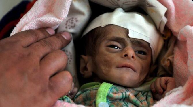 Ein Arzt untersucht ein drei Monate altes stark unterernährte Kind im Ernährungszentrum in Sanaa (Jemen). Foto: Yahya Arhab/A